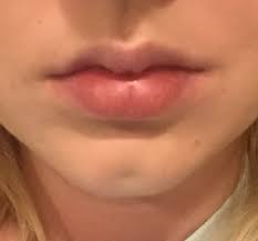 how to fix oddly shaped upper lip