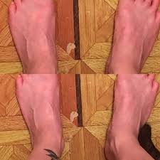 red purple feet but no swelling