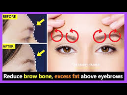 how to reduce brow bone naturally and