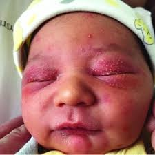 newborn with bilateral eyelid swelling
