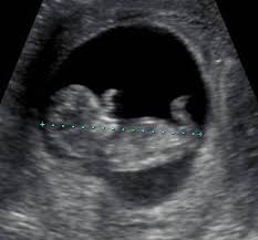 Normal 1st Trimester Ultrasound How To