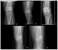 mr imaging in osteoarthritis
