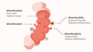 diverticulitis symptoms causes