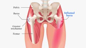 side outer hip pain