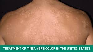 treatment of tinea versicolor in the