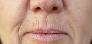 frowning lips causes treatment