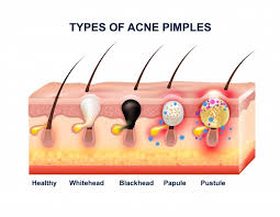 Pimple Diagram Area Wiring Diagrams