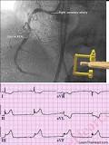 Image result for icd 10 code for inferior posterior stemi
