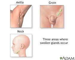 swollen lymph nodes medlineplus