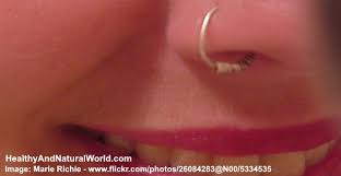 The first step in any nose piercing procedure involves piercing your nose to accommodate the ring. How To Get Rid Of Nose Piercing Bump Home Remedies That Really Work