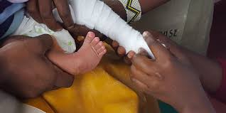 The main treatment, called the ponseti method, involves gently manipulating and stretching your baby's foot into a better position. Why Treating Clubfoot Results In More Than Mobility One