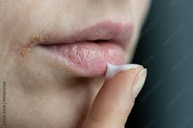 woman applying lip balm with finger to
