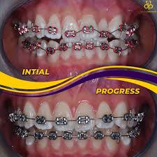 We offer braces, extraction, wisdom tooth, dental implant, cabut gigi, tampal gigi. Klinik Pergigian Kerajaan Johor Bahru