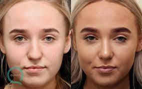 Check spelling or type a new query. Before And After Nose Job Photos Quaba Plastic Surgery Edinburgh Uk