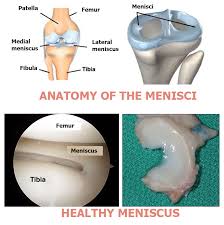 meniscus tear docteur bruno lévy