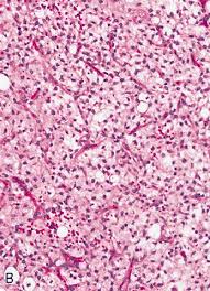 pathology outlines myxoid liposarcoma