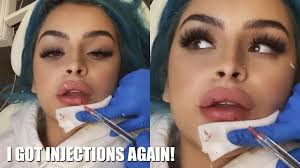 i got painless lip injections you