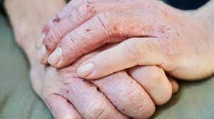 hand eczema pictures causes