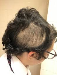 If so, then you need to find excellent hair salons within your area that can. Decided To Look For A Hair Salon Near Me To Cover Two Bald Spots On My Scalp People Were Disgusted By Me For Even Calling They Asked Oh What Is This You