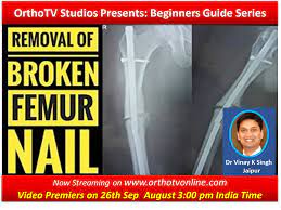 removal of broken femur nail