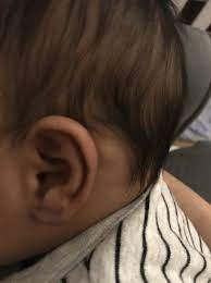 lump behind left ear babycenter