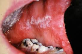 how to get rid of thrush in mouth 11