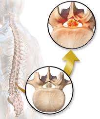 spinal stenosis regen doctors