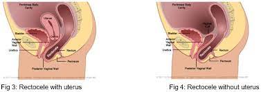pelvic floor repair anterior and