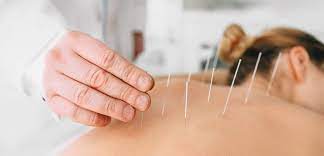 l acupuncture efficace pour prévenir