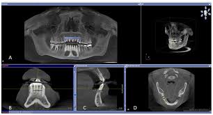 incisors rate and pattern of bone loss