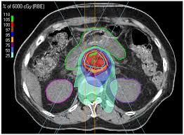 proton beam therapy for pancreatic cancer