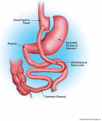 gastric byp surgery huntsville al