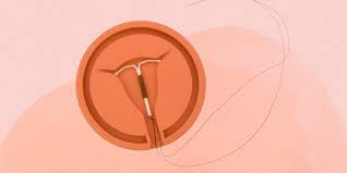 iud removal how it works and side