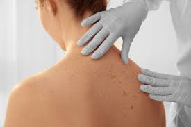 skin cancer treatment and skin checks