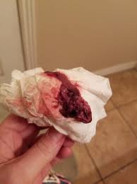 I went to my obgyn and she pulled out a piece of tissue in which she claimed it was a piece of a dicidual cast of my uterus. Endometrial Cast Tmi With Pic Babycenter
