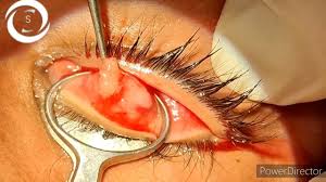 chalazion surgery in topical