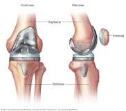 Image result for icd 10 code for presence of artificial left knee joint