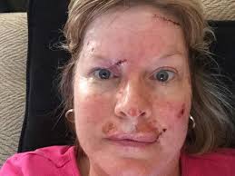 If you aren't sure which type of skin cancer. Woman Shares Shocking Selfies Showing Recovery From Skin Cancer Surgery In Warning Against Sunbeds And Not Using Suncream The Independent The Independent