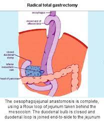 nutrition nutrition after gastrectomy