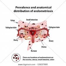 Example sentences from the web for endometriosis. Endometriosis Vector Photo Free Trial Bigstock