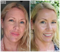 We used to think of lines and wrinkles as being women with darker skin tones, in particular, may believe they don't need sunscreen. How I Got Rid Of My Uneven Skin Tone Uneven Skin Uneven Skin Tone Face Tone