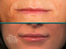 lip augmentation using your own natural