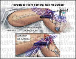 retrograde right fem nailing