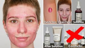 In this video, we'll find out! The Ordinary Azelaic Acid 10 Before Or After Moisturizer Itchy Face Tingling Youtube
