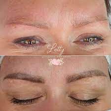 laser permanent makeup removal all