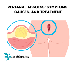 peri abscess symptoms causes