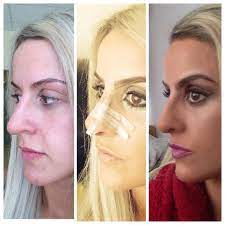 is it common after rhinoplasty the tip