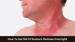 get rid of sunburn redness overnight