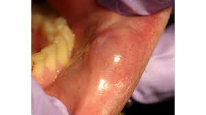 mucous cyst causes symptoms and
