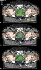 intensity modulated proton beam therapy